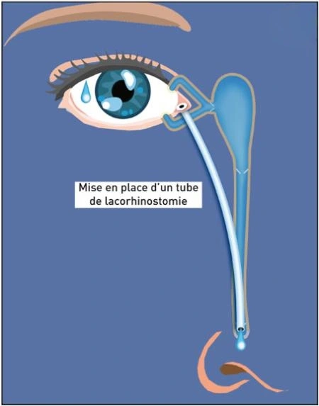 Lacorhinostomie Chirurgie des voies lacrymales (larmoiements) Dr Hervé Chenal IEVR Lacorhinostomie Chirurgie des voies lacrymales (larmoiements) Dr Hervé Chenal IEVR